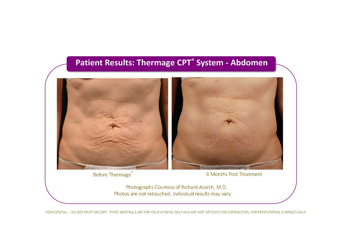 BeforAfter thermga Body 1